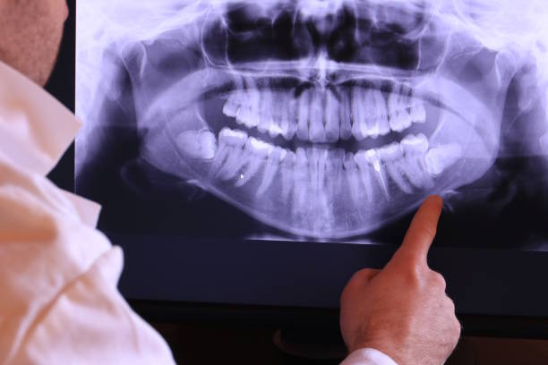 Best Emergency Root Canal Treatment in Kingston, WA