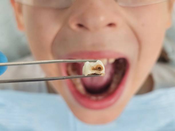 Best Broken or Cracked Tooth Emergency Dentist in Kingston, WA